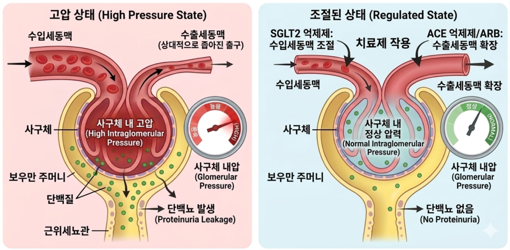 정상 사구체와 사구체 고혈압 비교 모식도. 사구체 고혈압 상태(왼쪽)와 ACE 억제제, ARB, SGLT2 억제제 복용을 통한 조절 상태(오른쪽)의 대조. 왼쪽 패널은 넓어진 수입세동맥과 좁아진 수출세동맥으로 인해 붉게 표시된 고압 상태와 단백뇨(초록색 점) 누출을 보여주며, 오른쪽 패널은 약물 작용으로 출구는 넓히고 입구는 조절하여 내압 게이지가 정상(초록색)으로 돌아오고 단백뇨가 멈춘 상태를 설명함.
정상혈압 혈압약 처방 의 원리를 설명함.